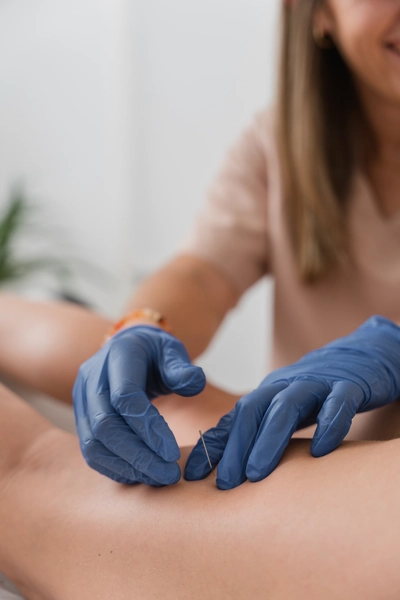 Fisioterapeuta aplicando Neuroacupuntura en Jerez